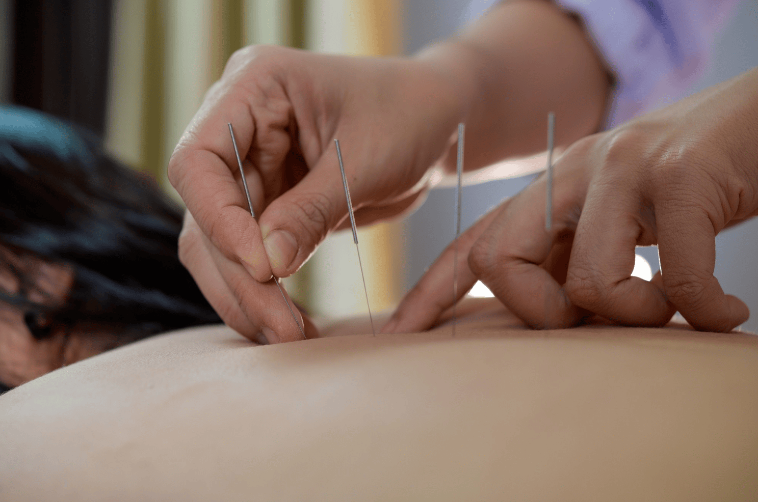 Acupuncture Carrara