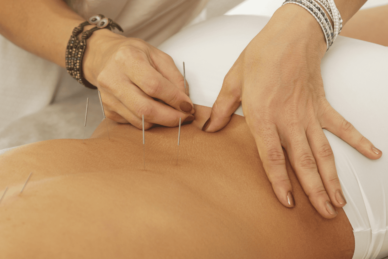 Acupuncture Mudgeeraba