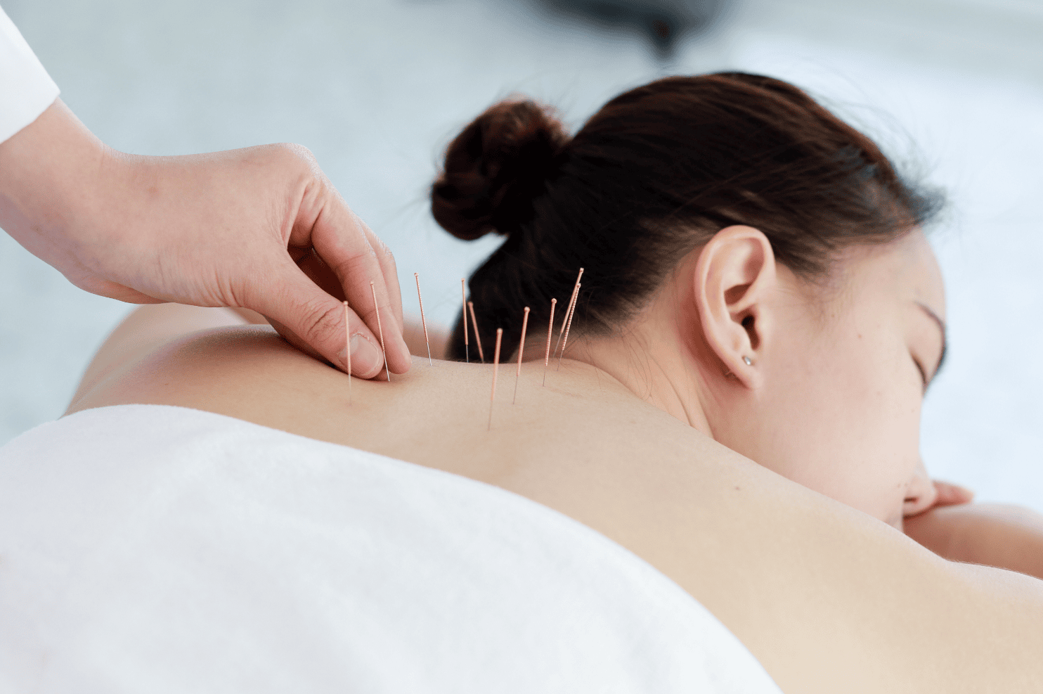 Acupuncture Worongary